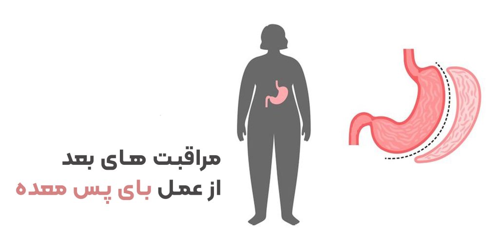 مراقبت های بعد از عمل مینی بای پس معده