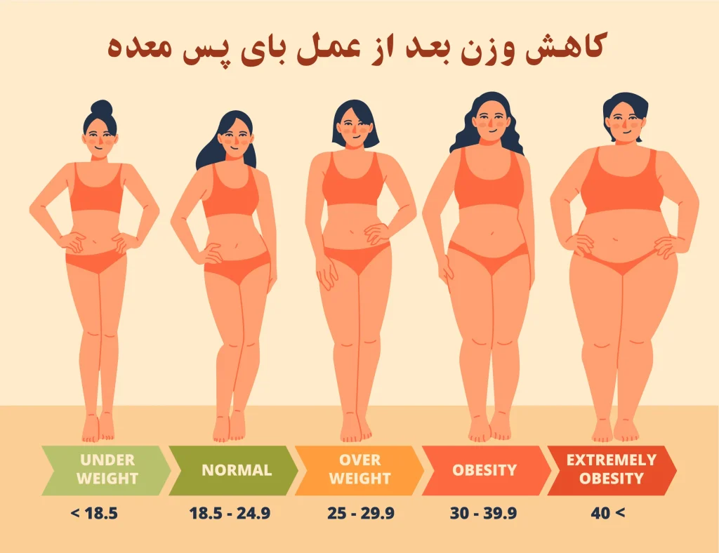 کاهش وزن بعد از عمل بای پس معده