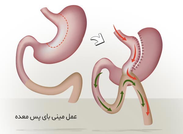  مینی بای پس معده