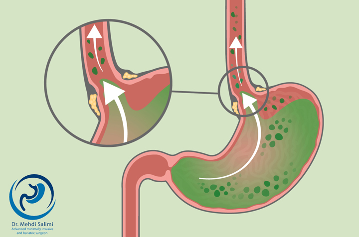 رفلاکس صفرا از عوارض عمل ساسی بای پس معده