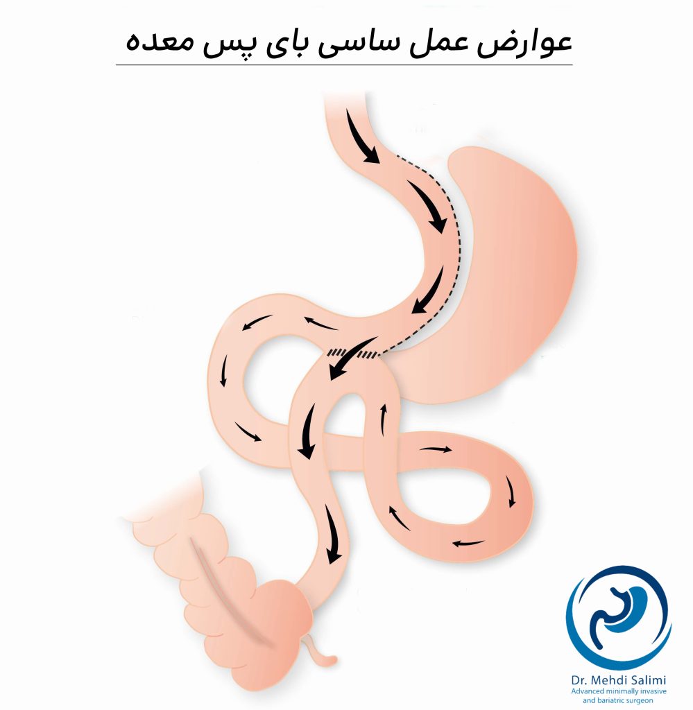 عوارض عمل ساسی بای پس