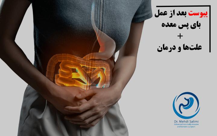 یبوست بعد از بای پس معده